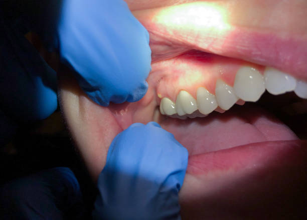 Best Emergency Wisdom Tooth Extraction in Princeton Junction, NJ