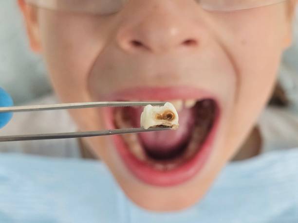 Best Knocked-Out Tooth (Avulsed Tooth) Treatment in Princeton Junction, NJ